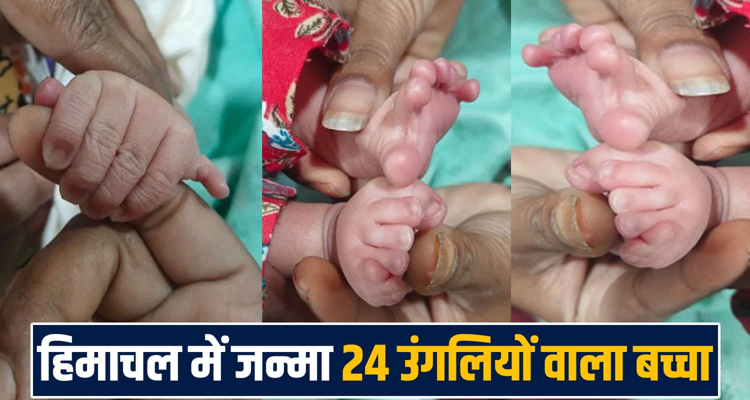 new born 24 fingers foot hand Polydactyly rare cases palampur hospital himachal normal delivery