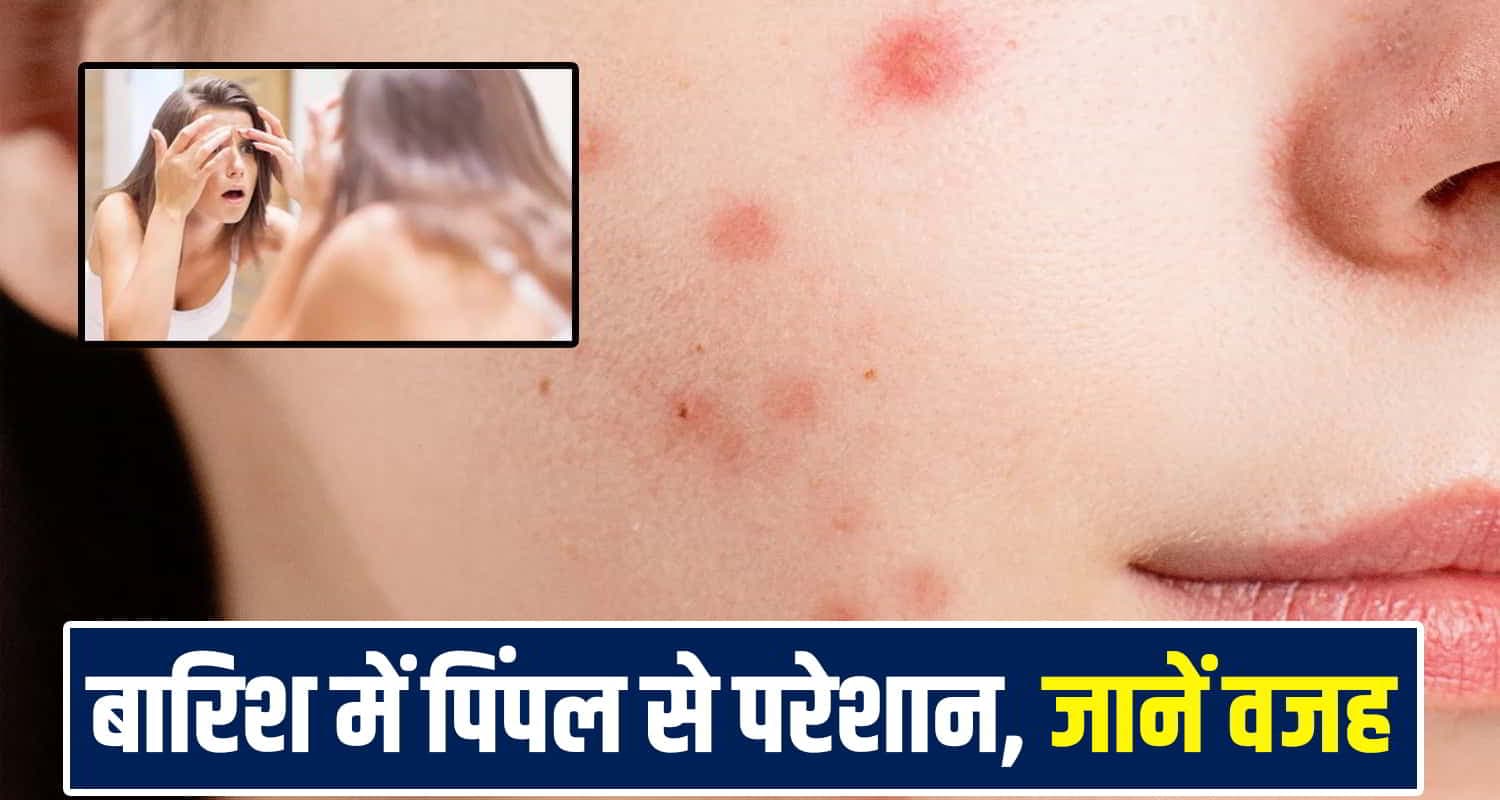 Monsoon Acne
