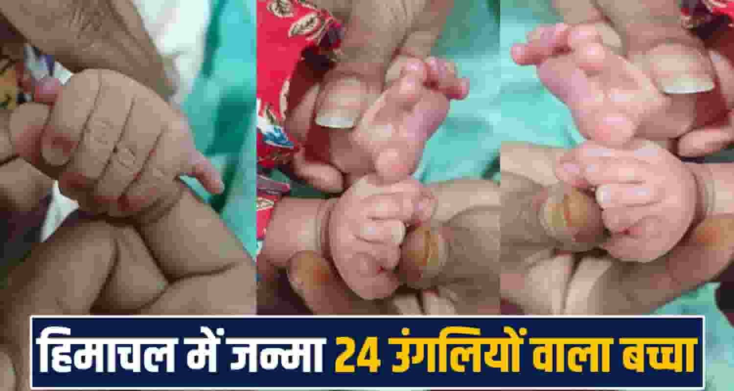 new born 24 fingers foot hand Polydactyly rare cases palampur hospital himachal normal delivery
