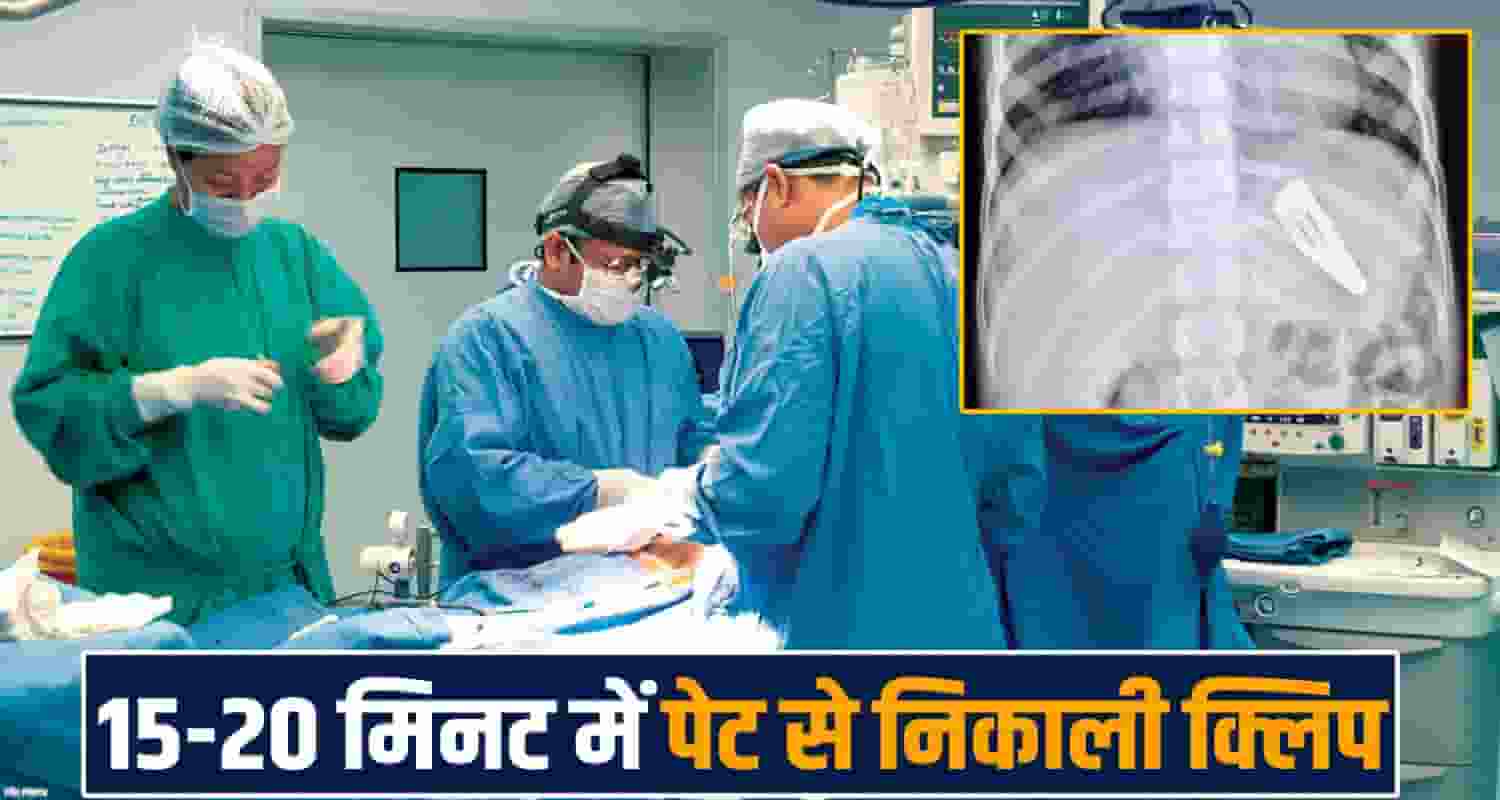 5-cm-hair-clip-stomach-igmc-shimla-doctors-remove-it-with-endoscopy