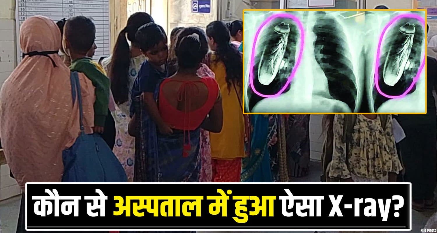 हिमाचल : मरीज की छाती में था जिंदा कॉकरोच! X-ray देख उड़े सबके होश- हुआ कुछ ऐसा Fake Patient Chest Xray